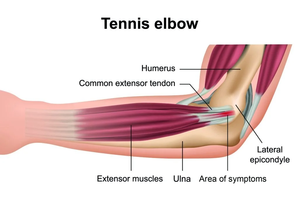 Best Tennis Elbow Trigger Points Therapy Find Relief Fast Guide