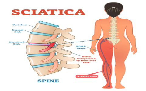 Sciatic nerve tennis ball benefits explained: Real ways to improve mobility without drugs.